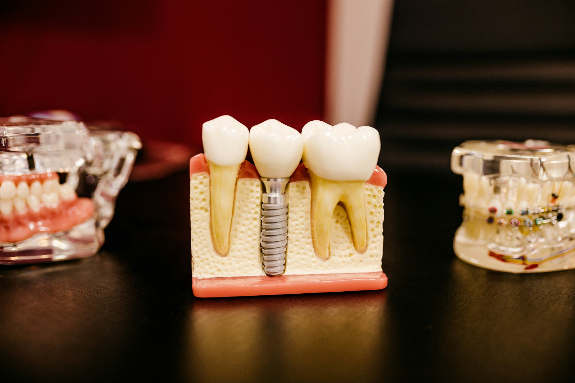 Dental implant teaching model beside orthodontic models